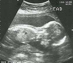 My niece - ultrasound